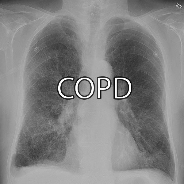 Chronic Obstructive Pulmonary Disease (COPD)