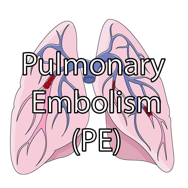 Pulmonary Embolism (PE) - Medical Notes